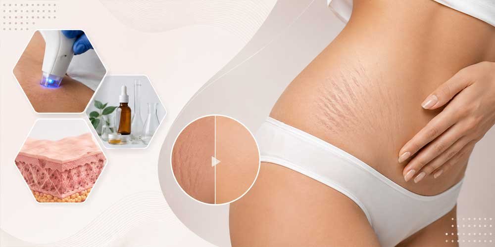 Stretch Mark Reduction